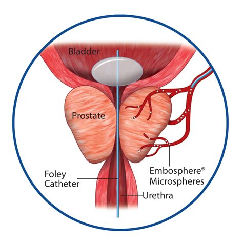 Ask The Expert Prostate Artery Embolization Desert Endovascular Center