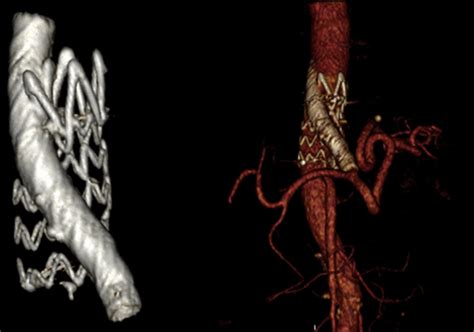 Computed Tomography Angiography Cta Three Dimensional Reconstructions