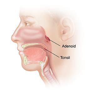 Understanding Tonsillectomy And Adenoidectomy Saint Luke S Health System