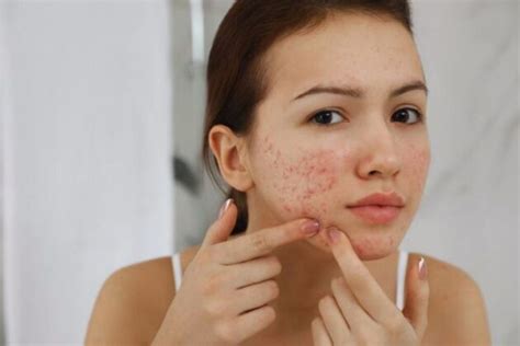 Acne Scars How To Get Rid Of Them