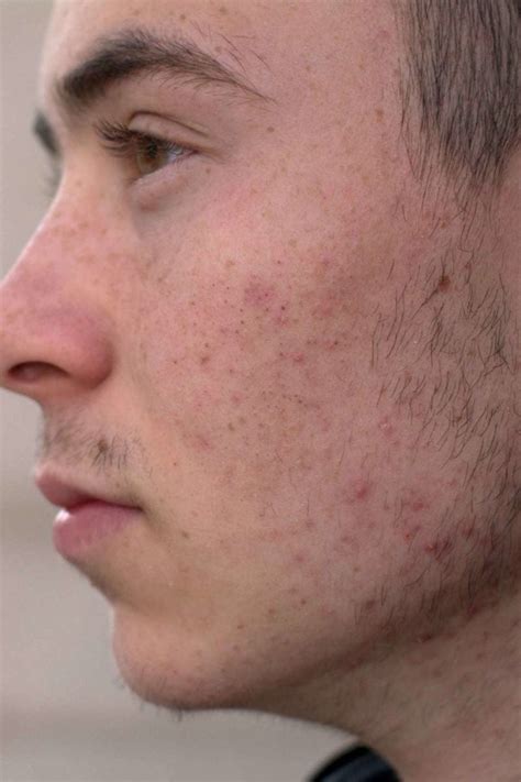 Masturbation Acne And Pimples What S The Link