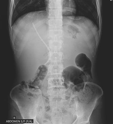 Ercp Stent