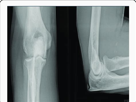 Late Radiographic Evaluation Of Right Elbow Patient Number 2