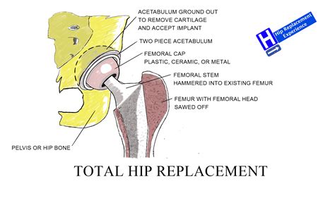 Hip Replacement Types With Images Hip Replacement
