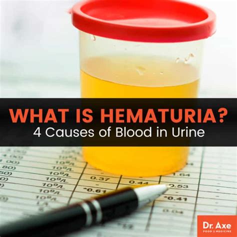 Hematuria Causes Of Blood In Urine 4 Natural Approaches Dr Axe