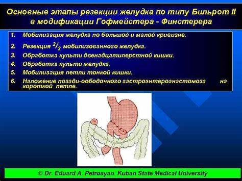 Диета послеоперационная при резекции желудка Операции на желудке © Dr. Eduard A. Petrosyan. Операции на желудке © Dr. Eduard A. Petrosyan. Диета послеоперационная при резекции желудка