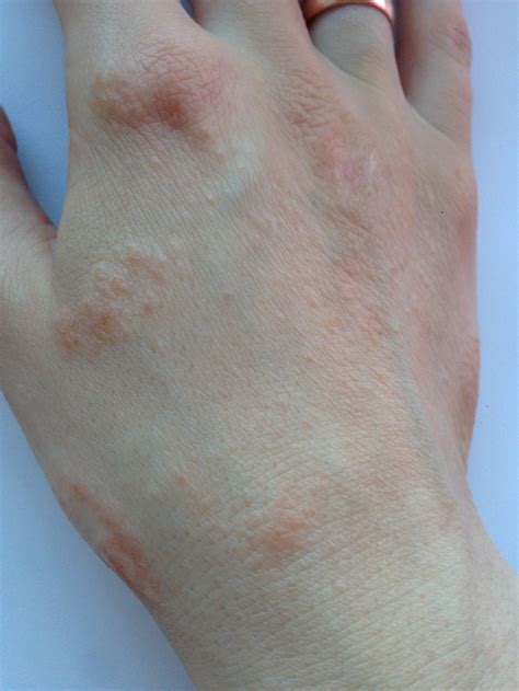 Мелкая сыпь на руках зуд и покраснение Вопрос дерматологу 03 Онлайн