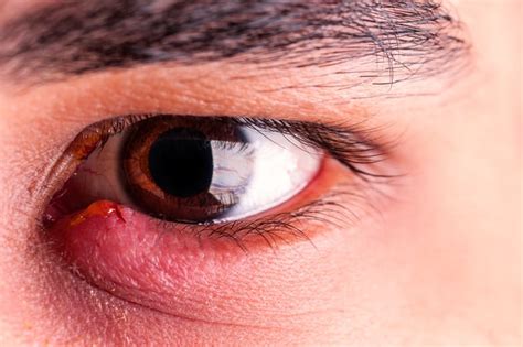 Blepharitis Causes Symptoms And Treatment