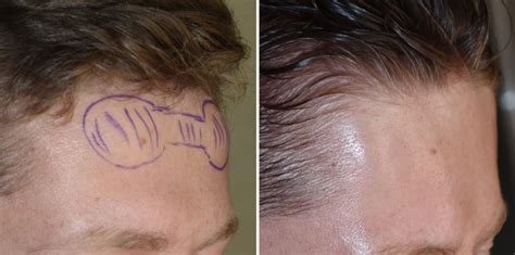 Forehead Horn Bony Forehead Reduction Intraop Dr Barry Eppley