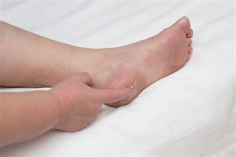 What Are Heel Spurs Causes Treatments Red Mountain Footcare