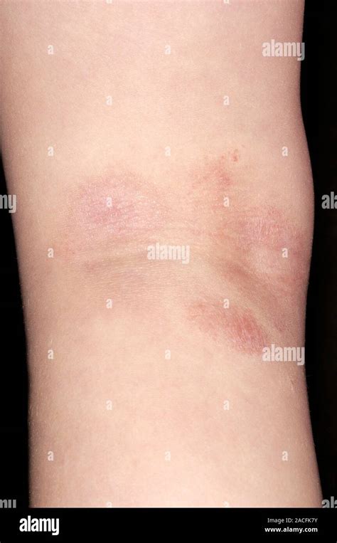Atopic Eczema Affecting The Skin On The Back Of A 3 Year Old Boys Knee
