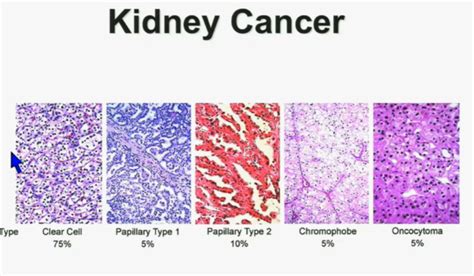 Kidney Renal Cell Cancer Pictures