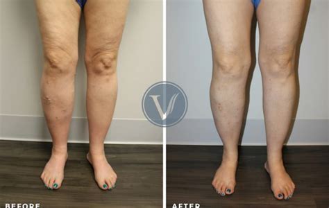 Treatment For Bulging Varicose Veins For 41yo Man The Vein Institute