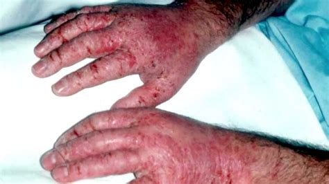 Occupational Skin Disease Youtube