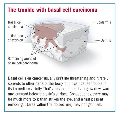 Basal Cell Carcinoma Harvard Health