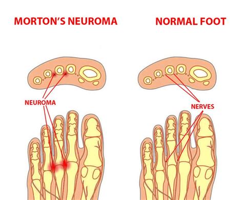 Mortons Neuroma Symptoms And Treatment Century Medical And Dental Center