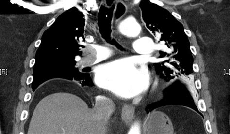 Lung Ultrasound For Diagnosis Of Pulmonary Embolism In Patients