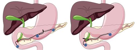 How To Do Eus Pancreatic Duct Access And Drainage Radiology Key