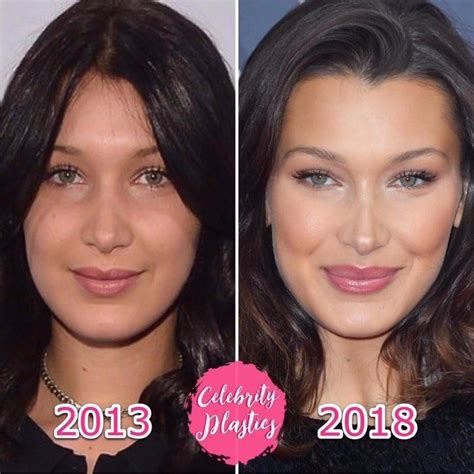 bella hadid plastic surgery before and after who magazine in 2020 rhinoplasty nose jobs