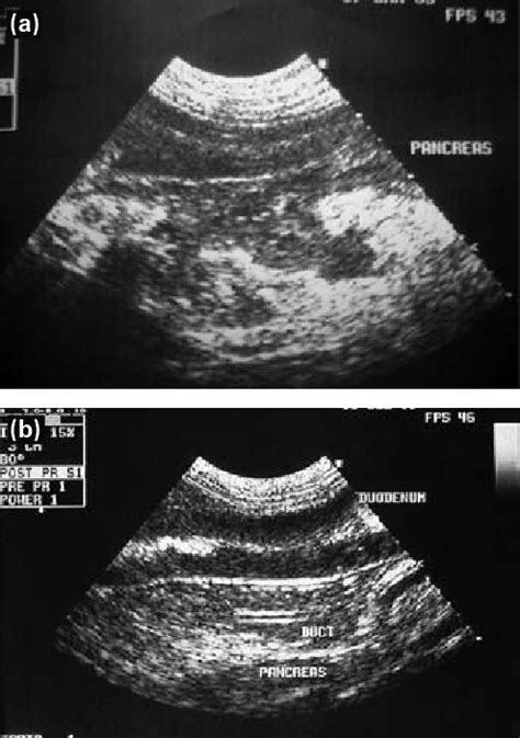 Appearance Of The Pancreas On Ultrasound In A A Clinical Case Of
