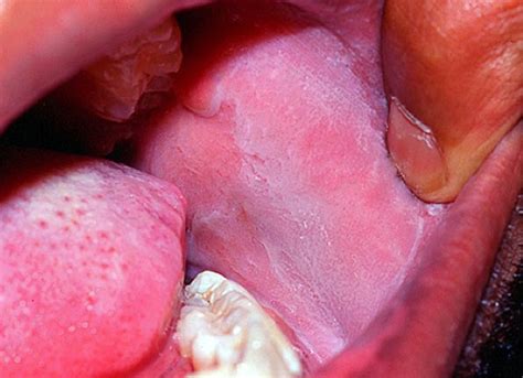 Hiv Symptoms Mouth