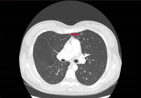 Distal‐type Bronchiolar Adenoma Of The Lung Harboring An Egfr Exon 21 P