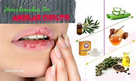 10 Natural Home Remedies For Angular Cheilitis Infection