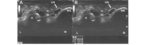 A Transverse Sonogram Of The Ulnar Nerve Arrow Within The Cubital