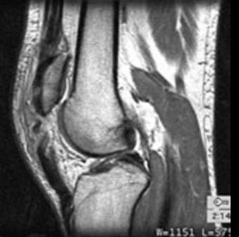 Patella Tendon Rupture X Ray