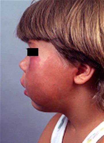 Causes Of Facial Swelling In Pediatric Patients Correlation Of