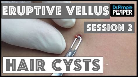 Eruptive Vellus Hair Cysts Session 2 Vellus Hair Cysts Hair