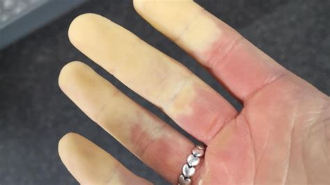 Raynauds Disease Impacts 1 In 5 People But Many Have Never Heard Of