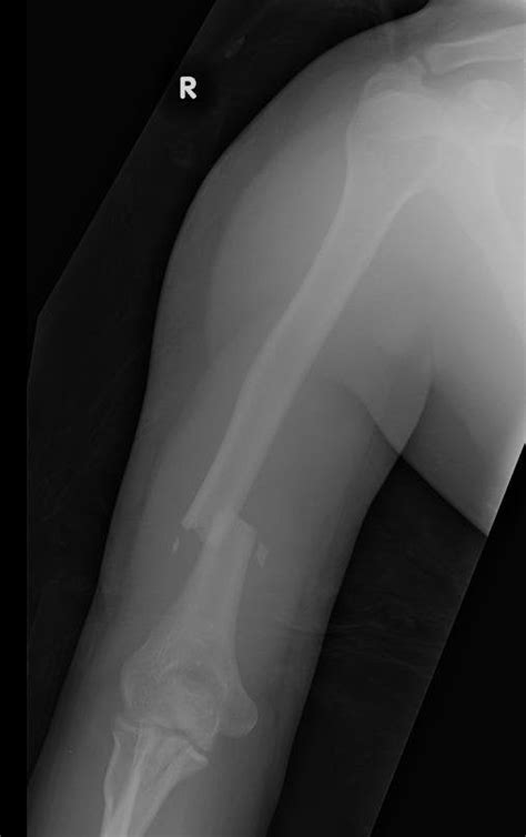 Fracture Distal Third Humerus And Comminuted Olecranon Fracture R