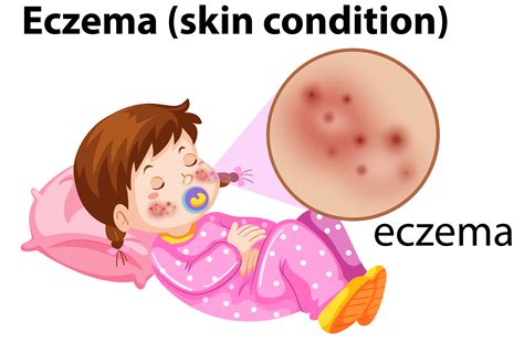 Top 168 Eczema Cartoon Images