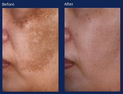 Chemical Peels Holzapfel Lied Plastic Surgery