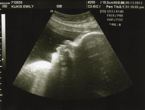 Gracie Ann Ultrasound Update 35 Weeks