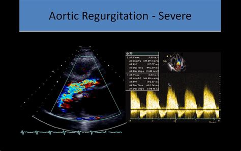 Aortic Regurgitation Pressure Half Time Sciencehub