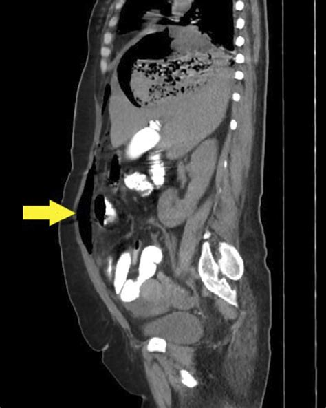 Preoperative Computed Tomography Image Of Ruptured Liver Hydatid Cyst
