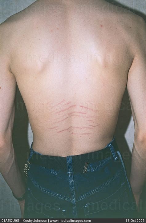 Stock Image Horizontal Stretch Marks Linear Striae Caused By A