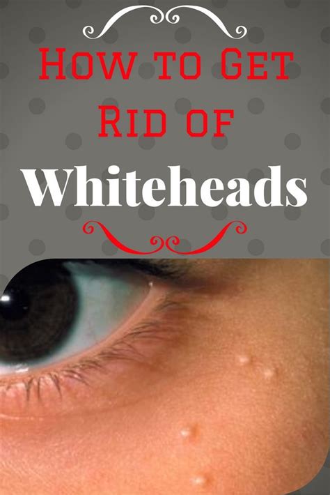How To Get Rid Of Whiteheads By Whiteheads Whiteheads