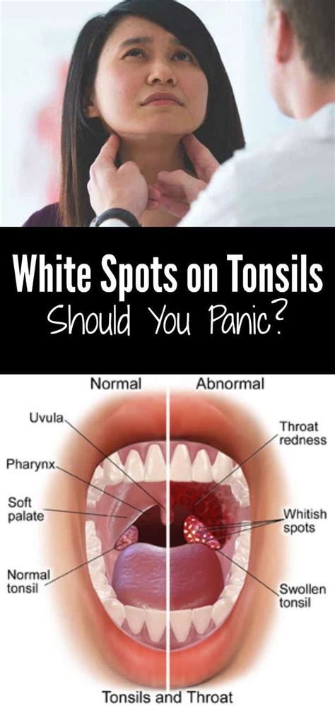 White Spots On Tonsils Should You Panic Swollen