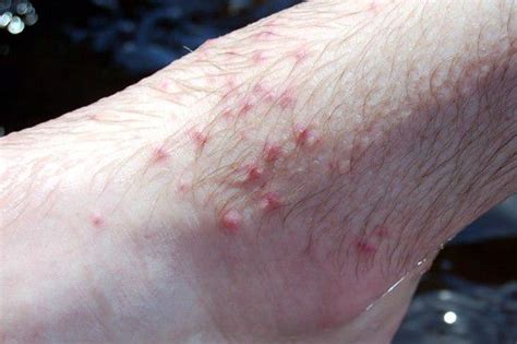Recognize And Treat Chigger Bites With Pictures