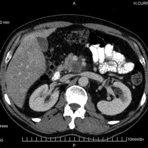 Contrast Enhanced Abdominal Ct Scan Axial View Hypovascular Lesions