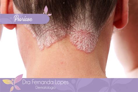 Dra Fernanda Lopes Dermatologia Blog Psoríase
