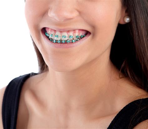 Frequently Asked Questions About Comprehensive Orthodontic Treatment