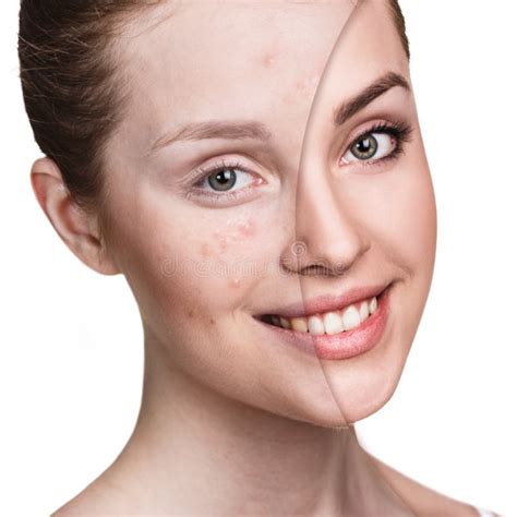 Girl With Acne Before And After Treatment Stock Image Image Of
