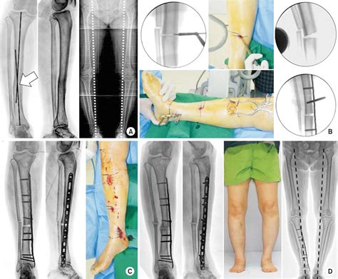 A Correction Of Malunion Or Deformity In The Lower Extremity