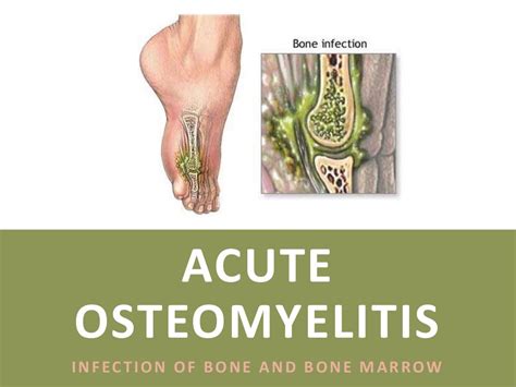 Acute Osteomyelitis