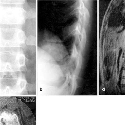 Ad Case 2 A Ap And B Lateral Radiographs Of The Lumbar Spine Reveal