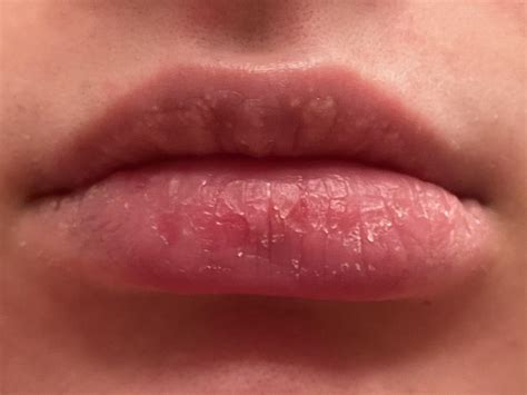 Skin Concerns Went On Accutane 5 Years Ago And My Lips Havent